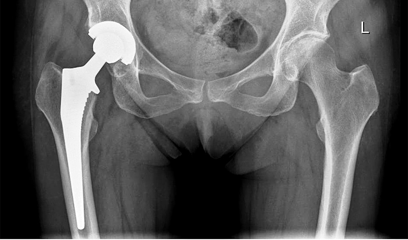 A total hip replacement performed by mr mohammed of the north west hip and clinic uk